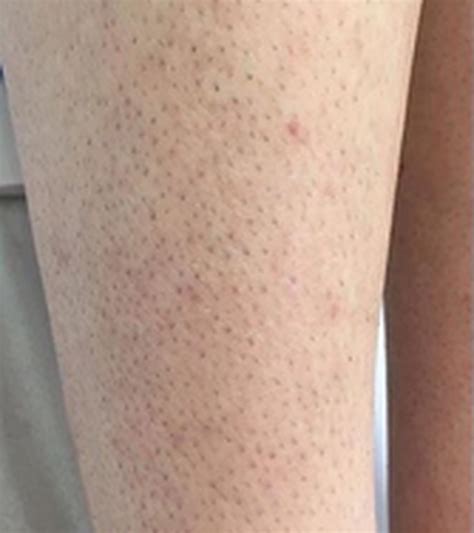 leg hair laser 1