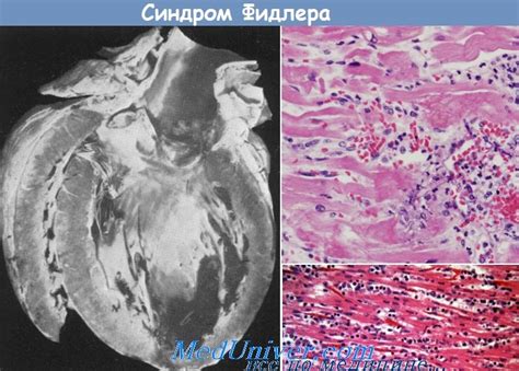 Синдром Фидлера (Fiedler) - синонимы, авторы, клиника