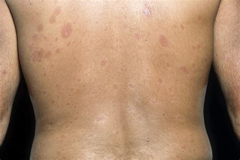 systemic sclerosis clinical features rare disease advisor