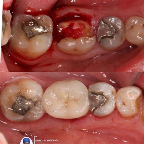 saving mission  fractured molar myzerodonto