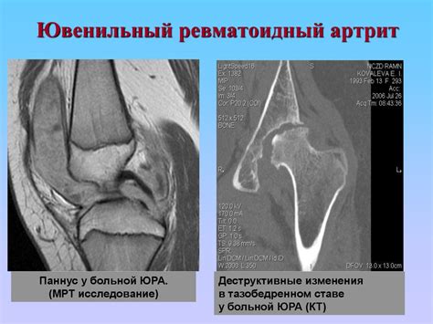 Ювенильный ревматоидный артрит - online presentation