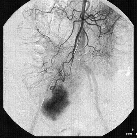 Selective superior mesenteric artery angiogram showing large feeding ...