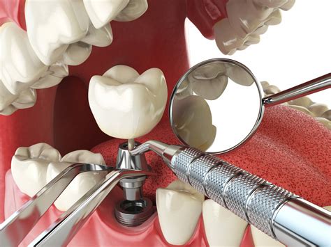 What Type of Specialist Performs Dental Implant Surgery?