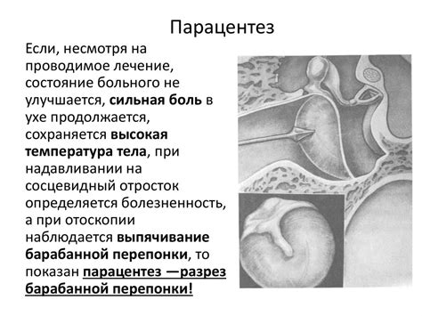 Острый гнойный перфоративный отит, особенности течения у детей ...