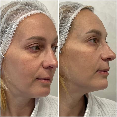 Контурна пластика Full Face Я завжди буду творити про те що Естетична ...