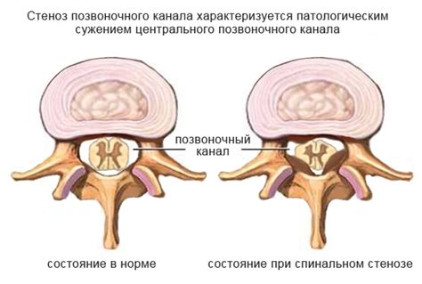 Стеноз позвоночника: симптомы и лечение, причины появления недуга ...