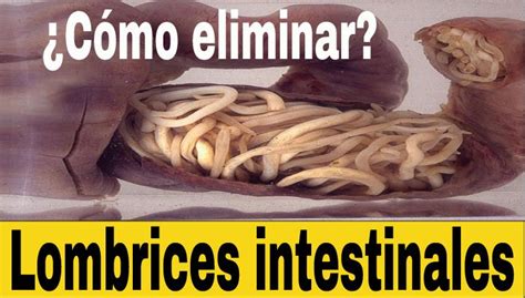 Cómo eliminar lombrices intestinales