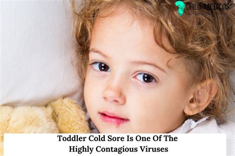 Toddler Cold Sore Is One Of The Highly Contagious Viruses - Daily Medicos
