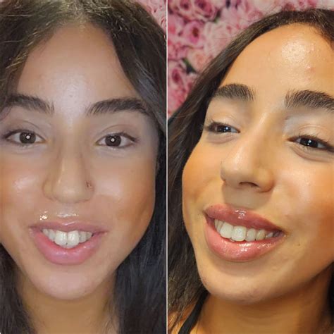 How much are Lip Filler in NJ | Lip Injections NJ - Berlin Beauty