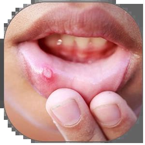 Foods & Mouth Sores | Healthreee