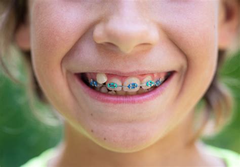 Fourways Dentist for Kids Braces