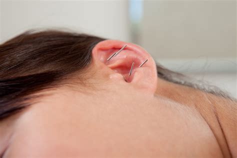 What is Ear Acupuncture and How Can It Help?