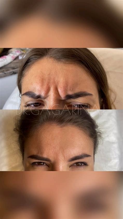 КОСМЕТОЛОГ ГУБЫ БОТОКС УГЛЫ FULL FACE 🇦🇪 ДУБАЙ | DUBAI (@dr.gagarina.l ...