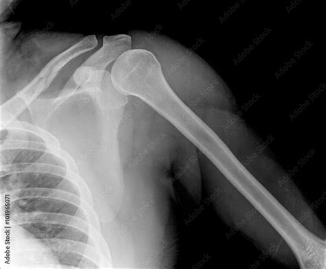 X-ray of shoulder joint / Many others X-ray images in my portfolio ...