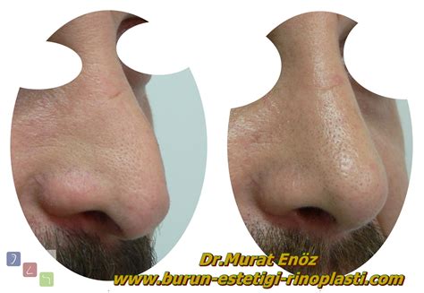 Health Zone Turkey: Pollybeak Deformity - Definition, Causes ...