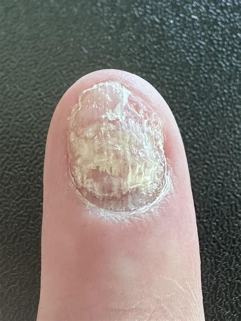 After 3 months on Terbinafine : r/NailFungus