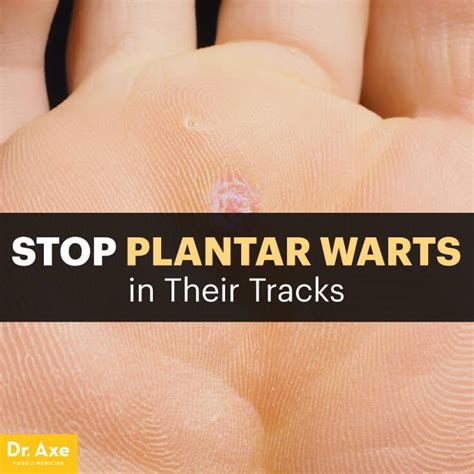 Stop Plantar Warts in Their Tracks with Natural Remedies - Dr. Axe