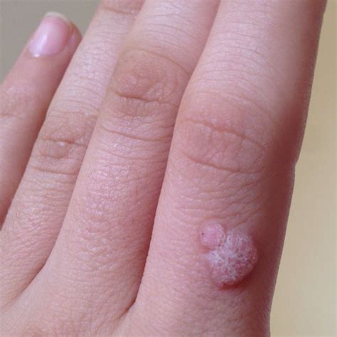 moles warts skin tags bumps