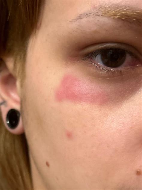 Itchy rash on face : r/DermatologyQuestions