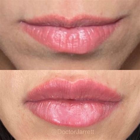 Lip fillers - Designer Aesthetics by Dr. Jarrett Schanzer | Miami