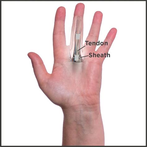 trigger finger  stenosing tenosynovitis worldbrace