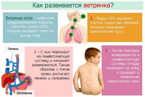 Ветряная оспа у ребенка. Причины, симптомы и лечение ветрянки у детей ...