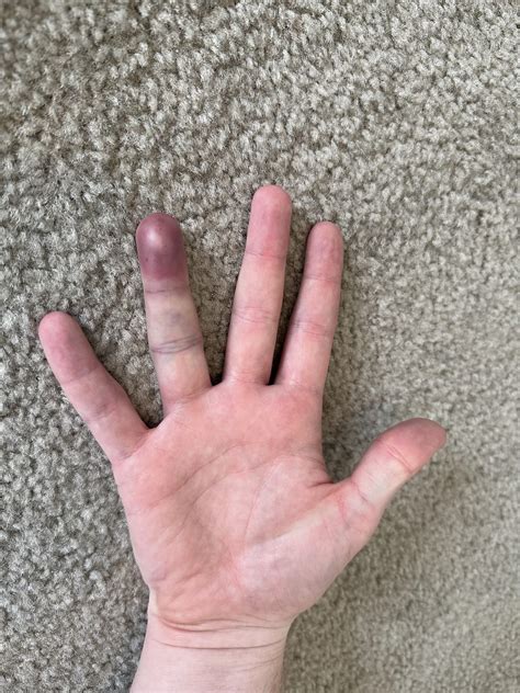 smashed finger treatment