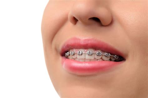 affordable braces  singapore student ceramic options