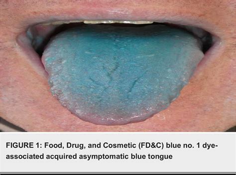 Figure 1 from Acquired Asymptomatic Blue Tongue: A Report of Exogenous ...