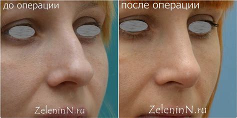 Пластика носа фото - Зеленин Н. В.