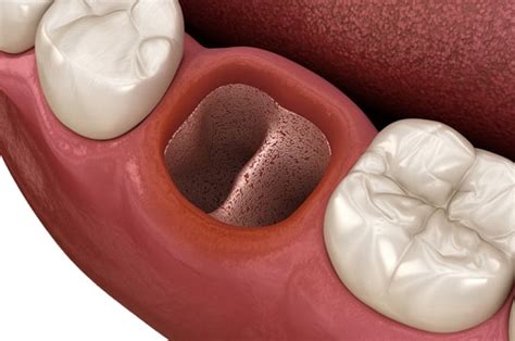 Что такое альвеолит зуба и как его лечить? | Silkdentist