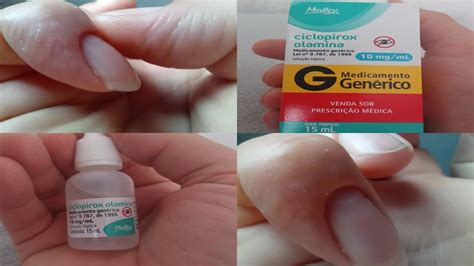 Ciclopirox Olamina Antes E Depois - #ciclopirox olamina Como curar fungos ou micose nas pontas dos dedos ...