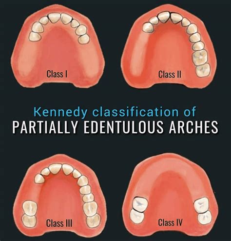 Kennedy Classification Dentures - Malia Rozalie