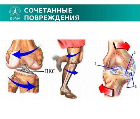 Коленный сустав - презентация, доклад, проект скачать