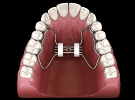 palatal expander white plains orthodontics