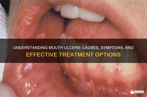 understanding mouth ulcers  symptoms  effective treatment