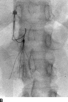 Inferior Vena Cava Filter Removal | Thoracic Key