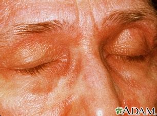 Dermatomyositis Information | Mount Sinai - New York