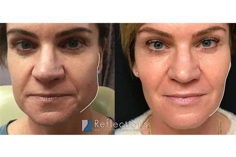 Botox for TMJ - Reflections Center