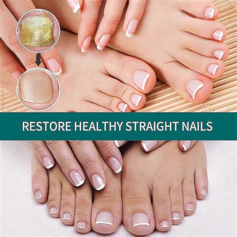 Toenail Repair Liquid Nail Fungus Hand And Foot Nail | Fruugo UK