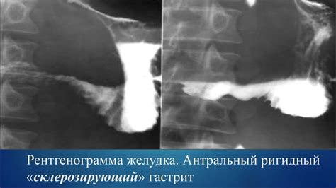 Лучевая анатомия ЖКТ - презентация онлайн