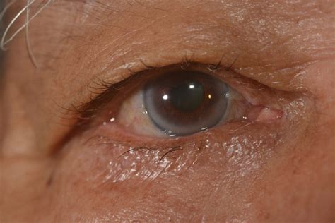 Corneal Arcus