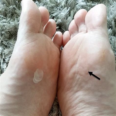 how to know if a blister is healing