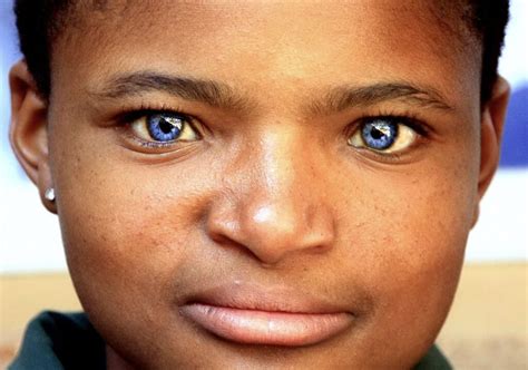 Sindrome De Waardenburg Fotos