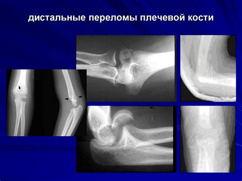 Переломы костей. Лечение переломов - презентация онлайн