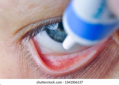 Implementation Drug Conjunctival Sac Instill Eye Stock Photo 1341006137 ...