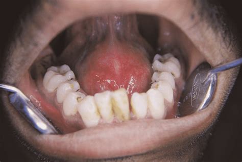Pre operative photo showing dome shaped sublingual swelling. | Download ...