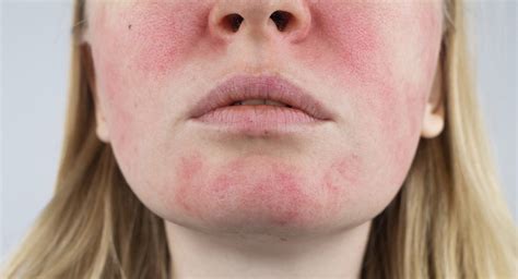 Case Study: Acne Rosacea | Liver Doctor