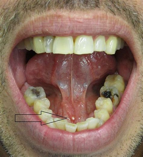 Submandibular Gland Duct