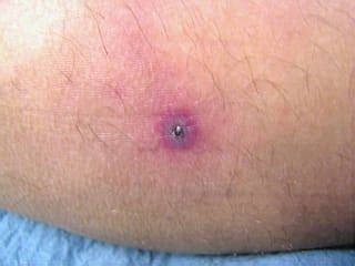 Rickettsios (tyfus, fläckfeber, kvalsterburen fläcktyfus [scrub typhus])